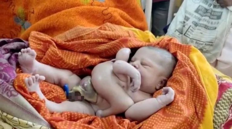 India: Baby born with a third arm